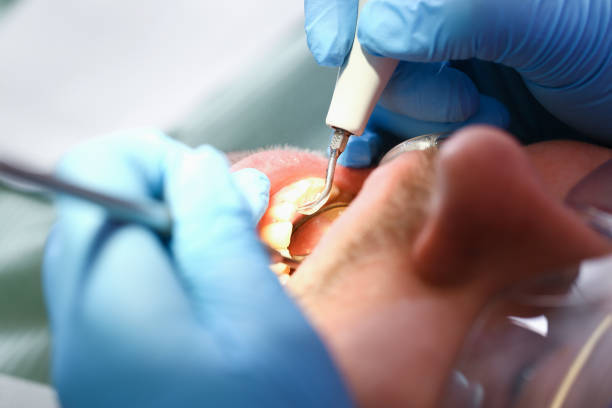 Best Emergency Root Canal Treatment in Dillsboro, IN